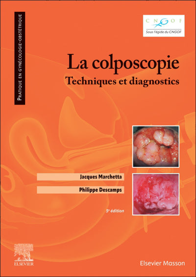 Colposcopie : techniques et diagnostics